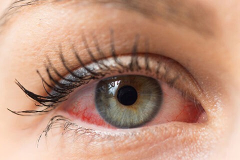 Ocular Surface Analysis and Dry Eye Clinic